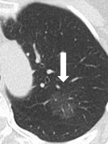 Radiologic Implications Of The 2011 Classification Of Adenocarcinoma Of