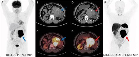 Figure 1 From 18F FDG PET CT And 68Ga DOTATATE PET CT Findings Of