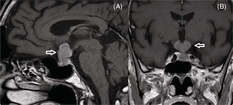 A Sagittal And B Coronal MRI On T1weighted Images With Gadolinium