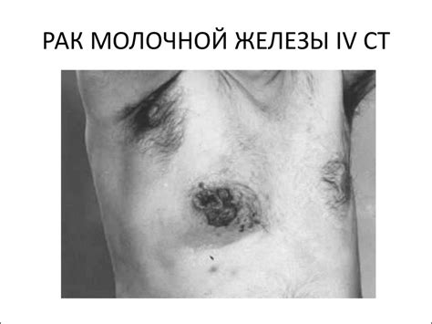 Острый лактационный мастит - презентация онлайн