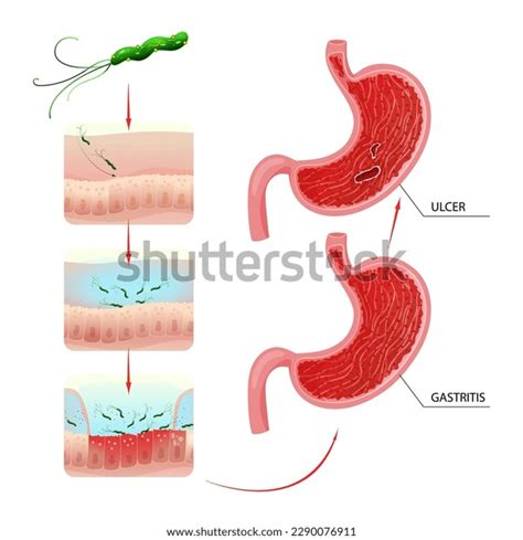 Helicobacter Pylori Infection Stomach Gastritis Ulcer Stock Vector (Royalty Free) 2290076911 ...