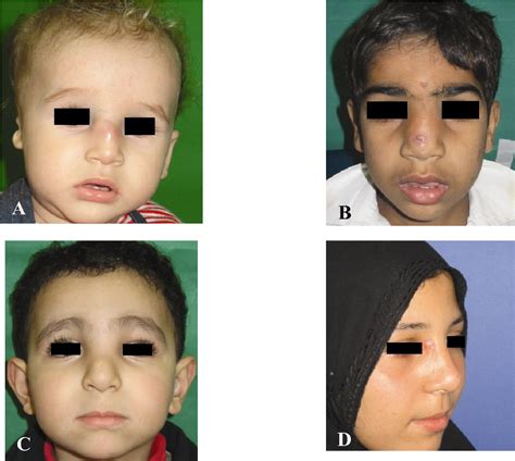 Figure 1 From Nasal Dermoid A Segmental Approach Semantic Scholar