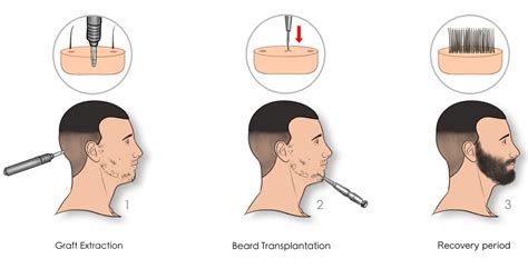 Beard Transplant In Turkey Procedure And Costs 2024