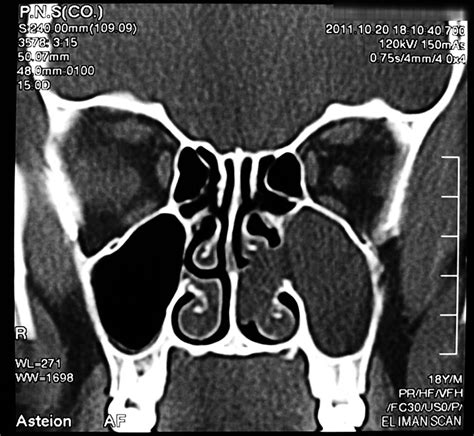 Nasal Polyp Ct Scan