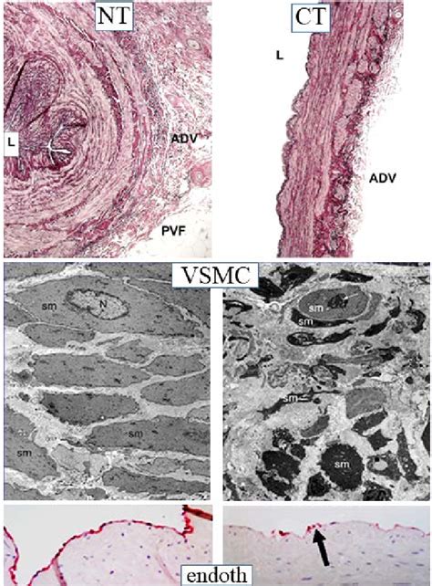 No Touch Nt Versus Conventional Ct Saphenous Vein Sv Vascular