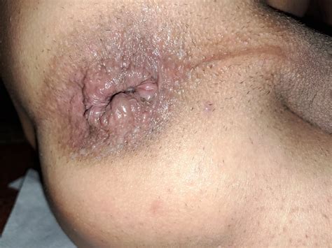 Prevention Of My Ass 17 Nude Pics XHamster