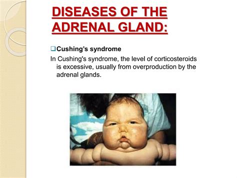 Adrenal Gland Ppt