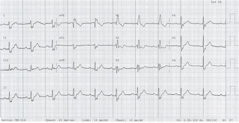 Bifascicular Block • Litfl • Ecg Library Diagnosis