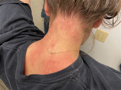 Stress Rash On Neck