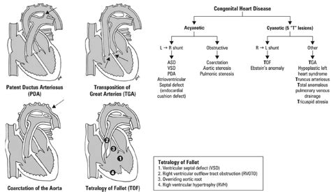 Congenital Heart Disease - SimplifiedMed!