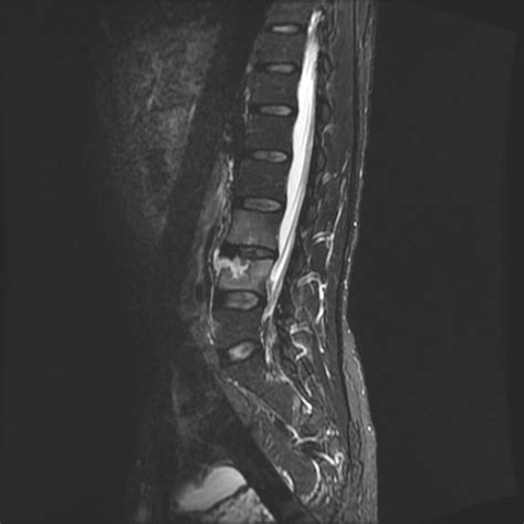 Brucella Spondylodiscitis Image