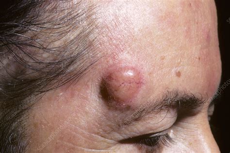 Skin Cancer Mycosis Fungoides