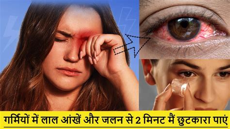 गर्मी और तेज धूप से आंखें हो जाती हैं लाल तो घर पर तुरंत करें ये 7 काम मिलेगी राहत Eye Care