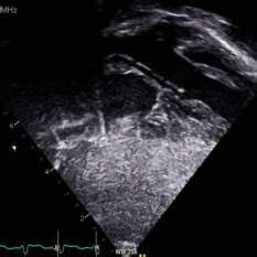 A Transthoracic Echocardiogram View In Long Axis Demonstrating The