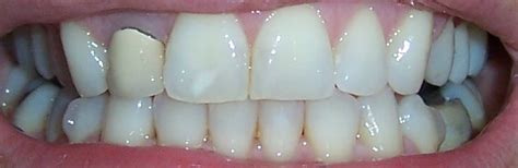 How They Remove Invisalign Attachments Or Buttons… – My Invisalign Blog