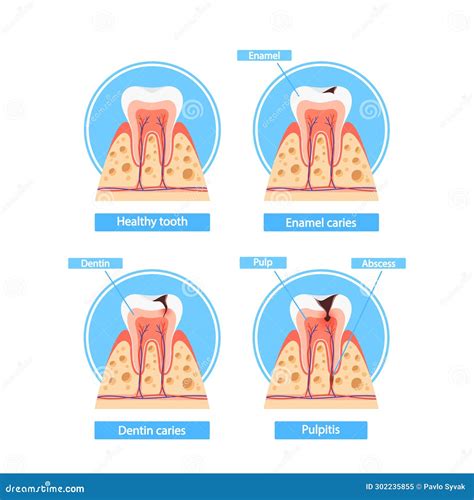 Caries Stages Infographics Healthy Tooth Enamel Caries Dentin Caries