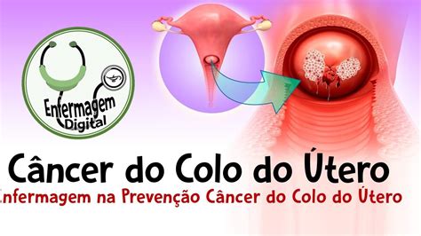 Prevenção do Câncer de Colo do Útero Papel da Enfermagem