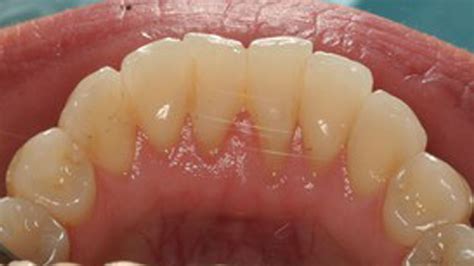 Gum Grafting Northbrook IL Gum Recession Dr Segal