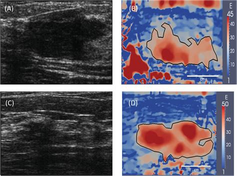 (A) and (C): B-mode ultrasound images of two typical invasive ductal ...