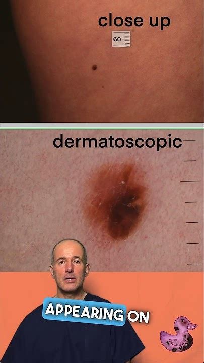 Dont Let Suspicious Moles Go Unnoticed Early Detection Can Save Lives