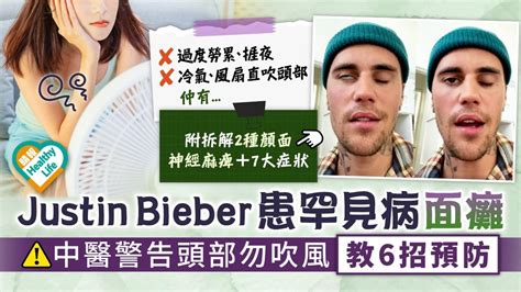 顏面神經麻痺︳justin Bieber患罕見病面癱 中醫警告頭部勿吹風教6招預防︳附7大症狀 晴報 健康 中醫養生 D220625