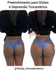 Preenchimento para Glúteo e Depressão Trocantérica Clínica Fit Body