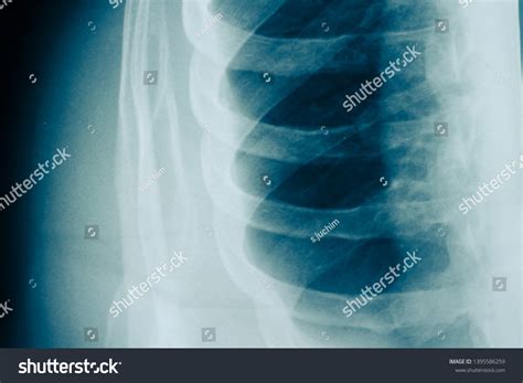 Human Rib Cage Xray Examination Photo Stock Photo (Edit Now) 1395586259