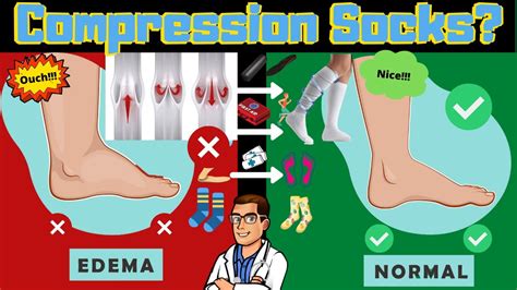 Are Compression Socks Worth It How To Fix Swollen Ankles And Feet