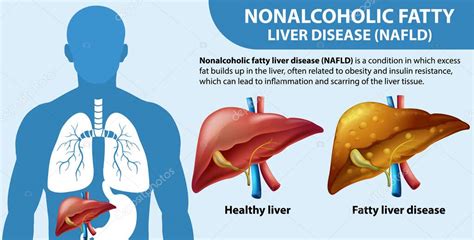 Enfermedad Hepática Grasa No Alcohólica NAFLD ilustración 2023