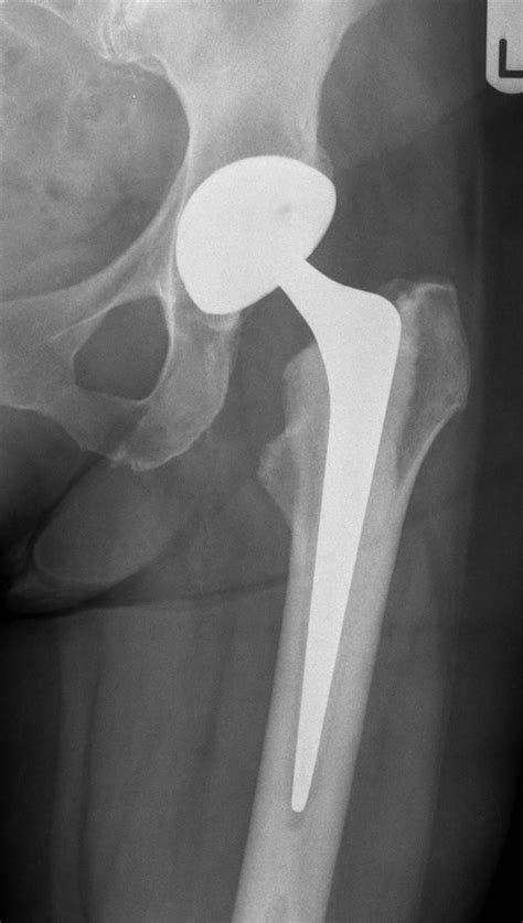 Catastrophic Failure Of Ceramic On Ceramic Total Hip Arthroplasty