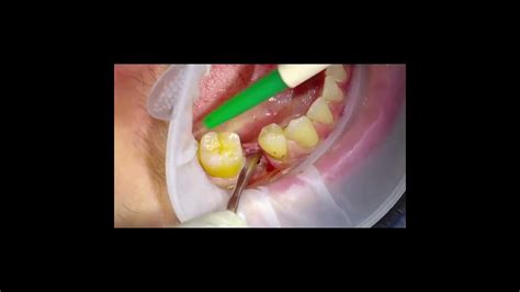 Dental Implants Procedure Youtube