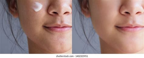 Image Before After Using Cosmetic Cream Stock Photo 1402325951 ...