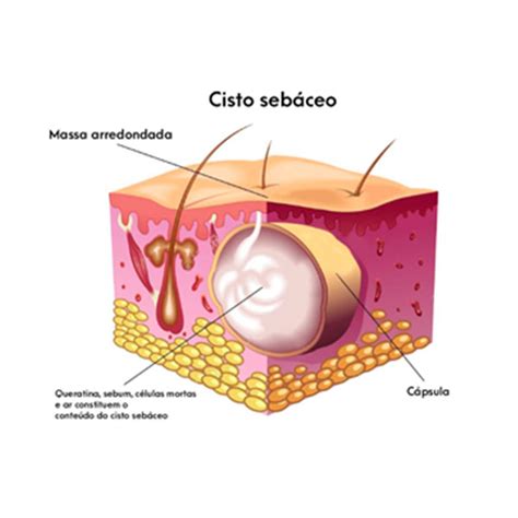 Cirurgia De Cisto Seb Ceo Dr Cl Udio Lemos