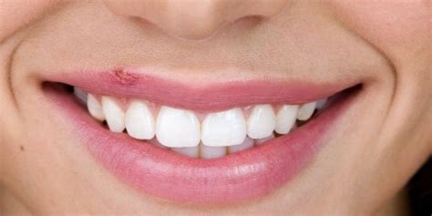 Consejos sobre herpes labial Farmacias de Maipú