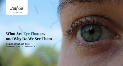What Are Floaters in the Eye? Causes, Symptoms, and When to Seek Help