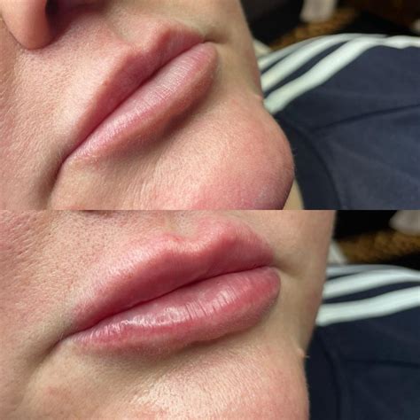 Lip Fillers Aesthetics Clinic Herefordshire