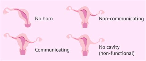 Types of unicornuate uterus