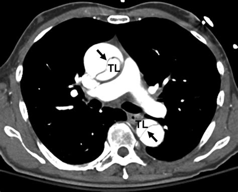 Presentation Of Acute Aortic Dissections Sinaiem