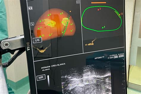 Biopsia Por Fusión Con Robot Artemis Ispro