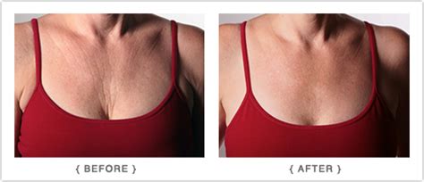 Chest Wrinkle Reducer Age Reverser