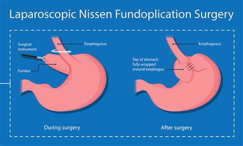 Is The Nissen Fundoplication For Gerd Worth It