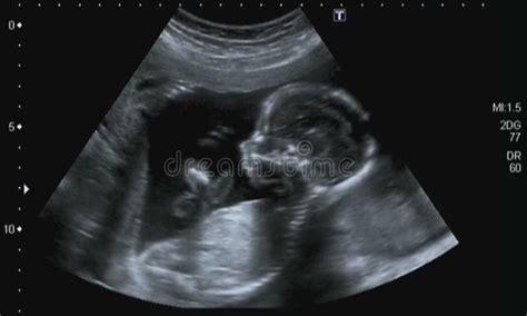 Obstetric Ultrasonography stock photo. Image of echographia - 15411898