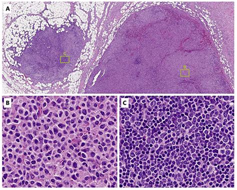 Conventional histology of cervical lymph node biopsy specimen. A ...