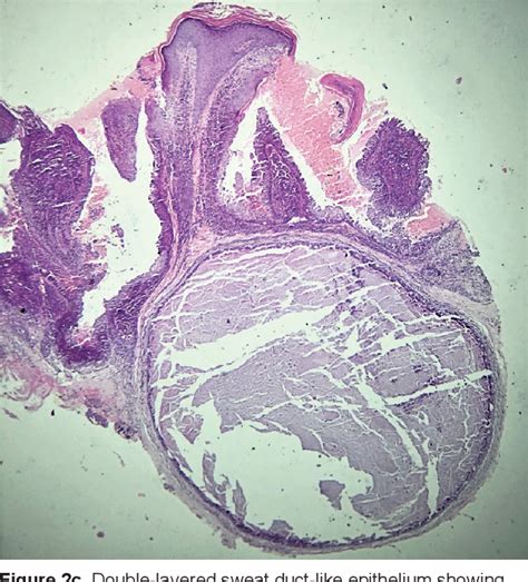 Figure From A Case Series Of Three Atypical Cases Of