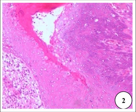 Scc Moderately Differentiated Multiple Squamous Cell Layers Hande 200×