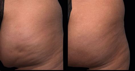 Cellulite Here Are The Best Cellulite Reduction Treatments