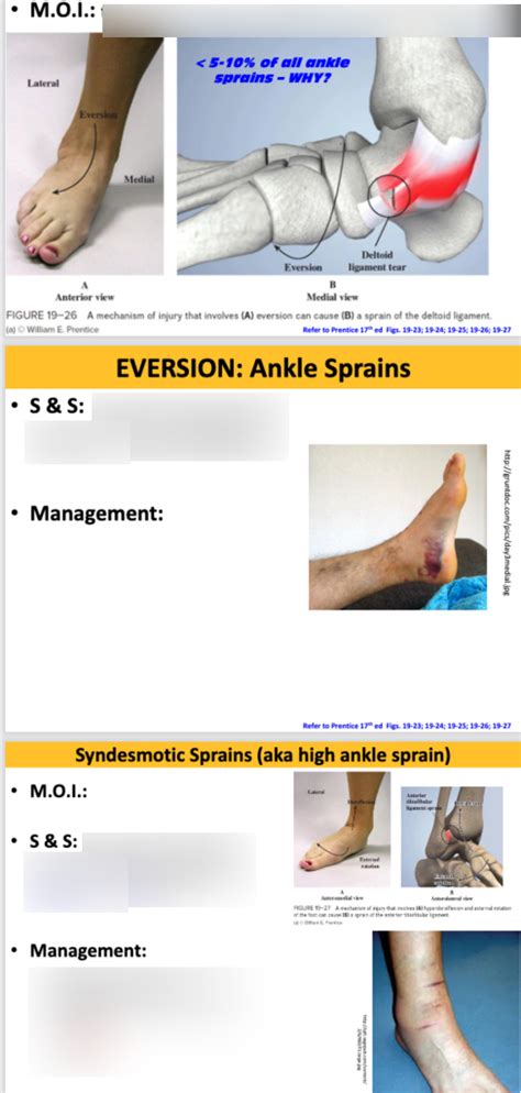 Eversion And Syndesmotic Ankle Sprains Diagram Quizlet