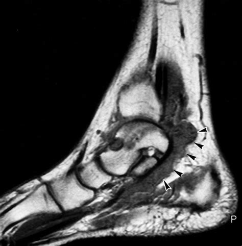 Calcaneal Spur Xray