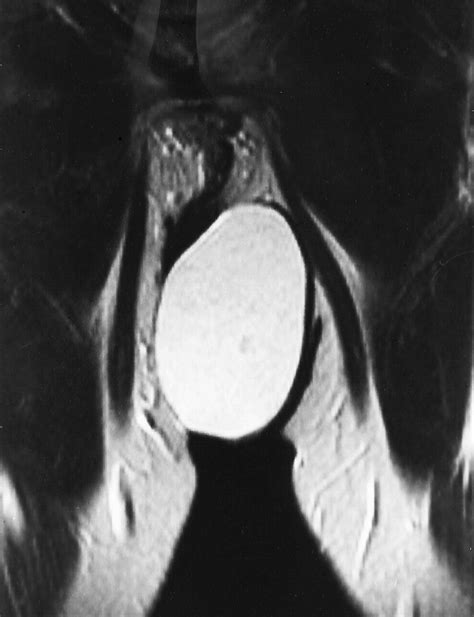 Myxoid Liposarcoma Appearance At MR Imaging With Histologic