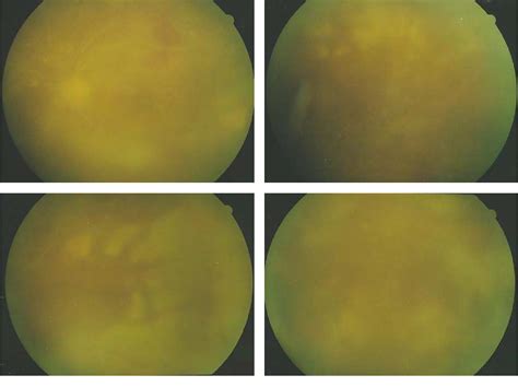 Figure From Vitrectomy And Silicone Oil Tamponade To Prevent Retinal